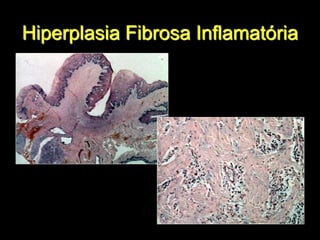 Hiperplasia Fibrosa Inflamatória
 