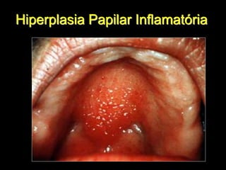 Hiperplasia Papilar Inflamatória
 