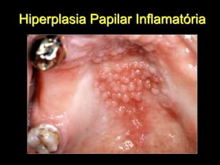 Hiperplasia Papilar Inflamatória
 