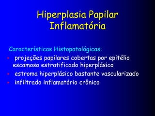 Hiperplasia Papilar
Inflamatória
Características Histopatológicas:
 projeções papilares cobertas por epitélio
escamoso estratificado hiperplásico
 estroma hiperplásico bastante vascularizado
 infiltrado inflamatório crônico
 