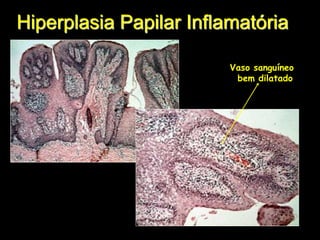 Vaso sanguíneo
bem dilatado
Hiperplasia Papilar Inflamatória
 