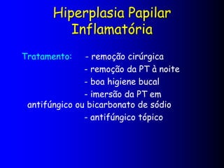Hiperplasia Papilar
Inflamatória
Tratamento: - remoção cirúrgica
- remoção da PT à noite
- boa higiene bucal
- imersão da PT em
antifúngico ou bicarbonato de sódio
- antifúngico tópico
 