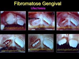 Fibromatose Gengival
Ulectomia
 