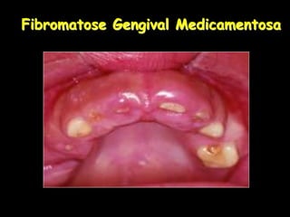 Fibromatose Gengival Medicamentosa
 