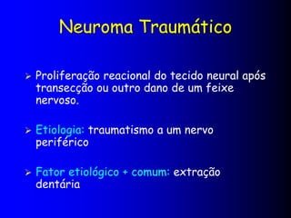 Neuroma Traumático
 Proliferação reacional do tecido neural após
transecção ou outro dano de um feixe
nervoso.
 Etiologia: traumatismo a um nervo
periférico
 Fator etiológico + comum: extração
dentária
 