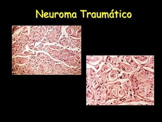 Neuroma Traumático
 