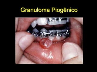 Granuloma Piogênico
 
