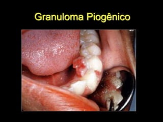 Granuloma Piogênico
 