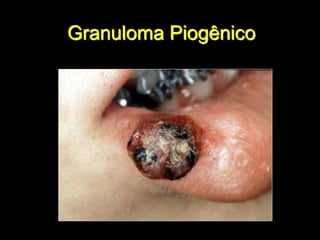 Granuloma Piogênico
 