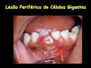 Lesão Periférica de Células Gigantes
 