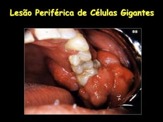 Lesão Periférica de Células Gigantes
 
