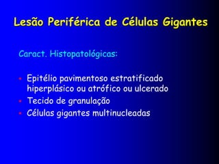 Lesão Periférica de Células Gigantes
Caract. Histopatológicas:
 Epitélio pavimentoso estratificado
hiperplásico ou atrófico ou ulcerado
 Tecido de granulação
 Células gigantes multinucleadas
 