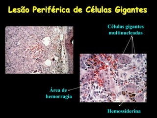 Lesão Periférica de Células Gigantes
Células gigantes
multinucleadas
Área de
hemorragia
Hemossiderina
 