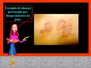 Exemplo de doença provocada por fungo (micose) na pele: 