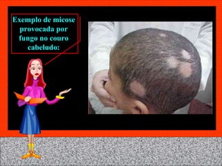 Exemplo de micose provocada por fungo no couro cabeludo: 