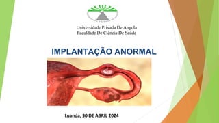 IMPLANTAÇÃO ANORMAL
Universidade Privada De Angola
Faculdade De Ciência De Saúde
Luanda, 30 DE ABRIL 2024
 