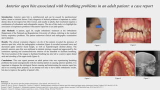 Anterior open bite associated with breathing problems in an adult patient: a case report
Introduction: Anterior open bite is multifactorial and can be caused by parafunctional
habits, dental or skeletal factors. Early diagnosis of skeletal problems is important as, unlike
dental, they do not regress but often worsen, and usually in adults, their resolution requires a
combination of orthodontic and orthognathic surgery. The aim of this study is to highlight the
association of respiratory problems with anterior open bite in an adult patient.
Aim/ Methods: A patient, aged 38, sought orthodontic treatment at the Orthodontic
Department of the National and Kapodistrian University of Athens, referring to her medical
history respiratory problems. The patient underwent clinical and radiographic examination
and evaluation.
Results: The clinical evaluation (figures 1,2,3,4) of the patient revealed the presence of
anterior open bite, while the radiographic evaluation (figure 4) revealed increased lower and
decreased upper anterior facial height, as well as hyperdivergent skeletal planes. The
patient's anterior open bite was attributed to skeletal etiology, caused and aggravated by the
continuous opening and counterclockwise rotation of the mandible to facilitate breathing.
The lower position of the tongue to facilitate breathing has also led to a narrow upper dental
arch and crowding of the upper teeth (figure 4).
Conclusions: This case report presents an adult patient who was experiencing breathing
problems that acted synergistically with her skeletal pattern in causing anterior openbite. It is
important to diagnose the etiological factors causing and deteriorating the anterior open bite
and to try treating them properly, in an attempt not only to have stable orthodontic results,
but also to improve the quality of patient’s life.
Figure 1 Figure 2
Figure 4
Figure 3
References
Champagne M. The anterior open bite problem (infraclusion). J Gen Orthod. 1995 Jun;6(2):5-10.
Gracco A, Perri A, Siviero L, Bonetti GA, Cocilovo F, Stellini E. Multidisciplinary correction of anterior open bite relapse and upper airway obstruction. Korean J Orthod. 2015 Jan;45(1):47-56.
Reichert I, Figel P, Winchester L. Orthodontic treatment of anterior open bite: a review article--is surgery always necessary? Oral Maxillofac Surg. 2014 Sep;18(3):271-7.
Rijpstra C, Lisson JA. Etiology of anterior open bite: a review. J Orofac Orthop. 2016 Jul;77(4):281-6.
Figure 5
 