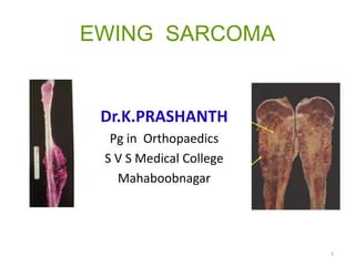 EWING SARCOMA
Dr.K.PRASHANTH
Pg in Orthopaedics
S V S Medical College
Mahaboobnagar
1
 