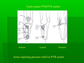 Total contact PTB/PTS socket
Areas requiring pressure relief in PTB socket
Anterior Lateral Posterior
 