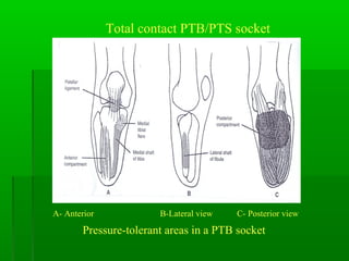 Total contact PTB/PTS socket
A- Anterior B-Lateral view C- Posterior view
Pressure-tolerant areas in a PTB socket
 