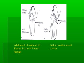 Abducted distal end of
Femur in quadrilateral
socket
Ischial containment
socket
 
