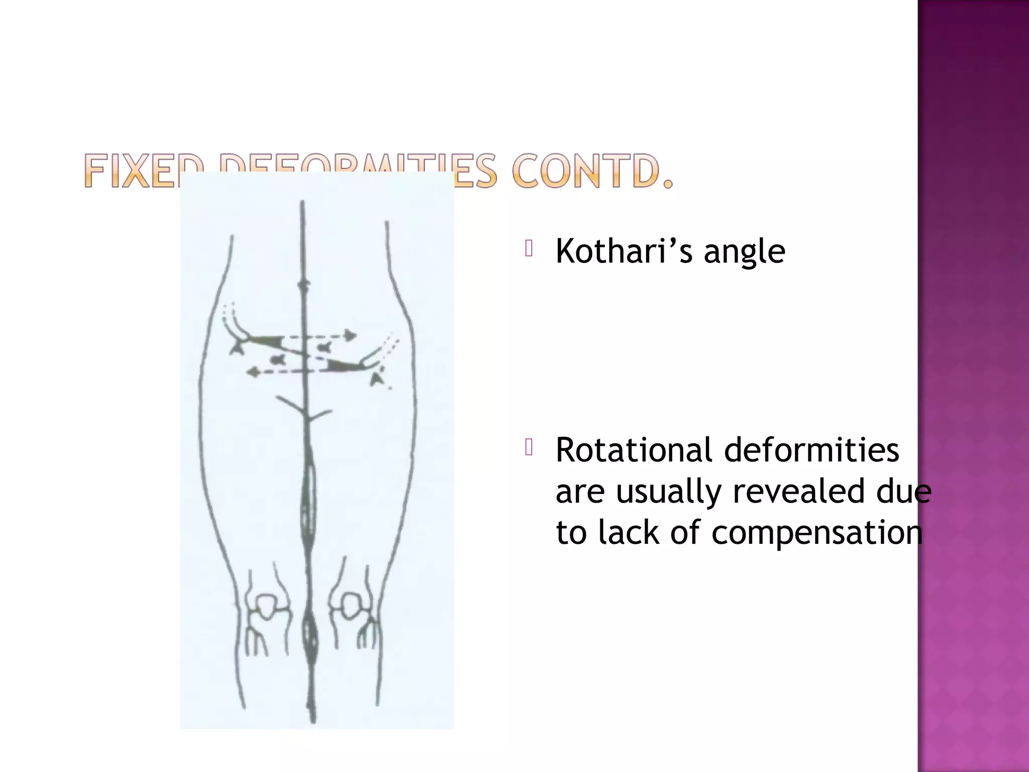   Kothari’s angle




   Rotational deformities
    are usually revealed due
    to lack of compensation
 