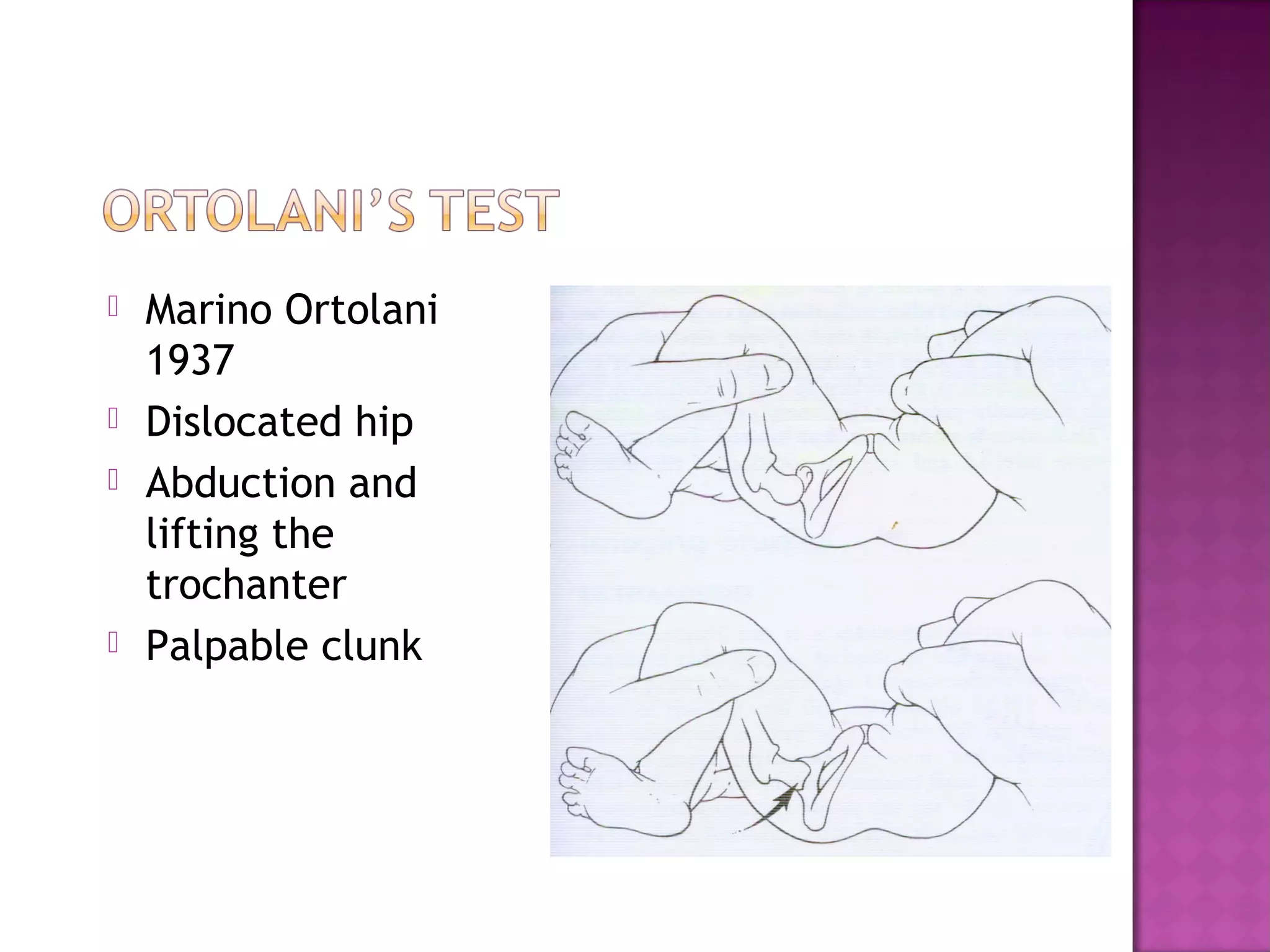    Marino Ortolani
    1937
   Dislocated hip
   Abduction and
    lifting the
    trochanter
   Palpable clunk
 