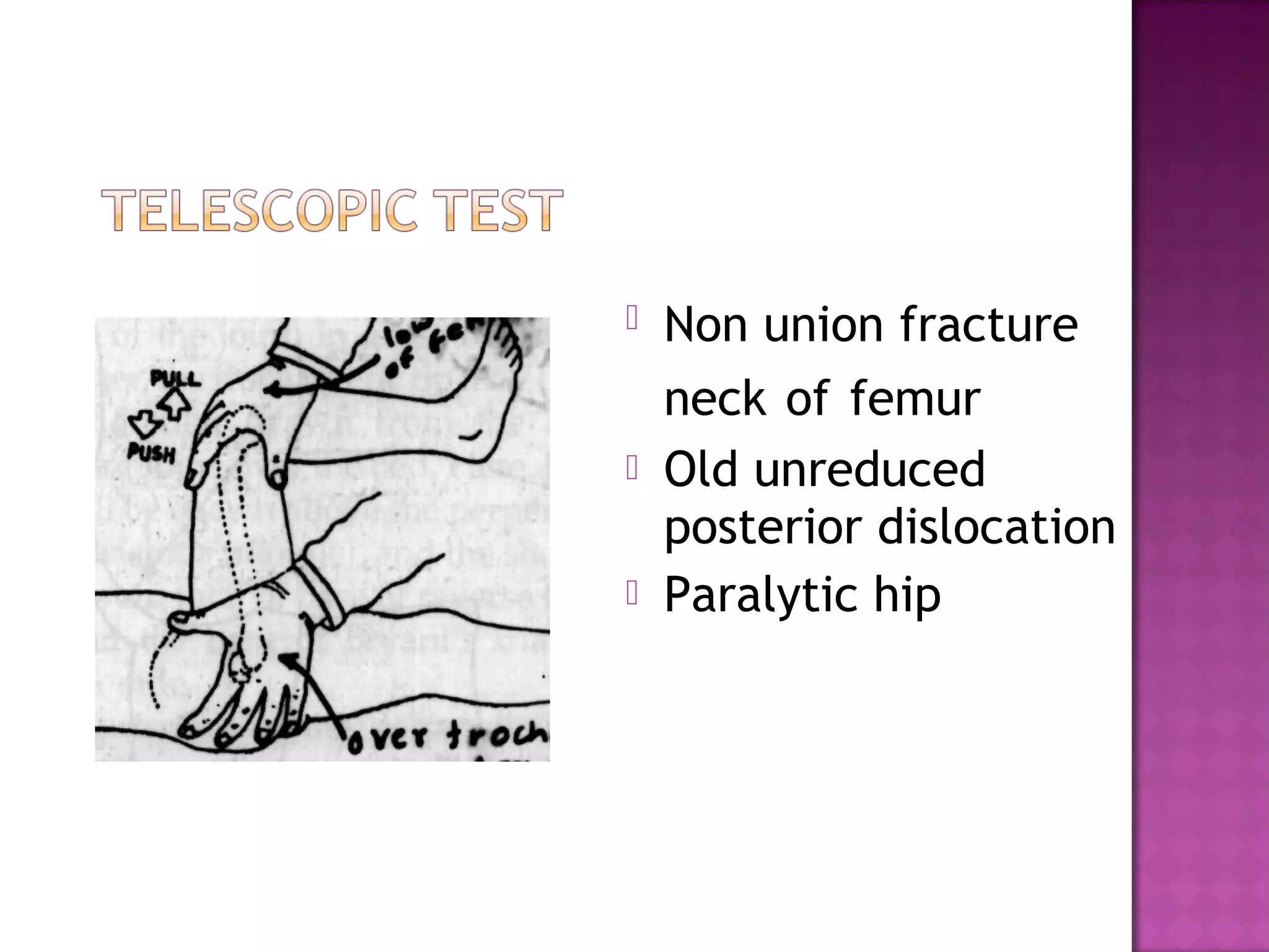    Non union fracture
    neck of femur
   Old unreduced
    posterior dislocation
   Paralytic hip
 