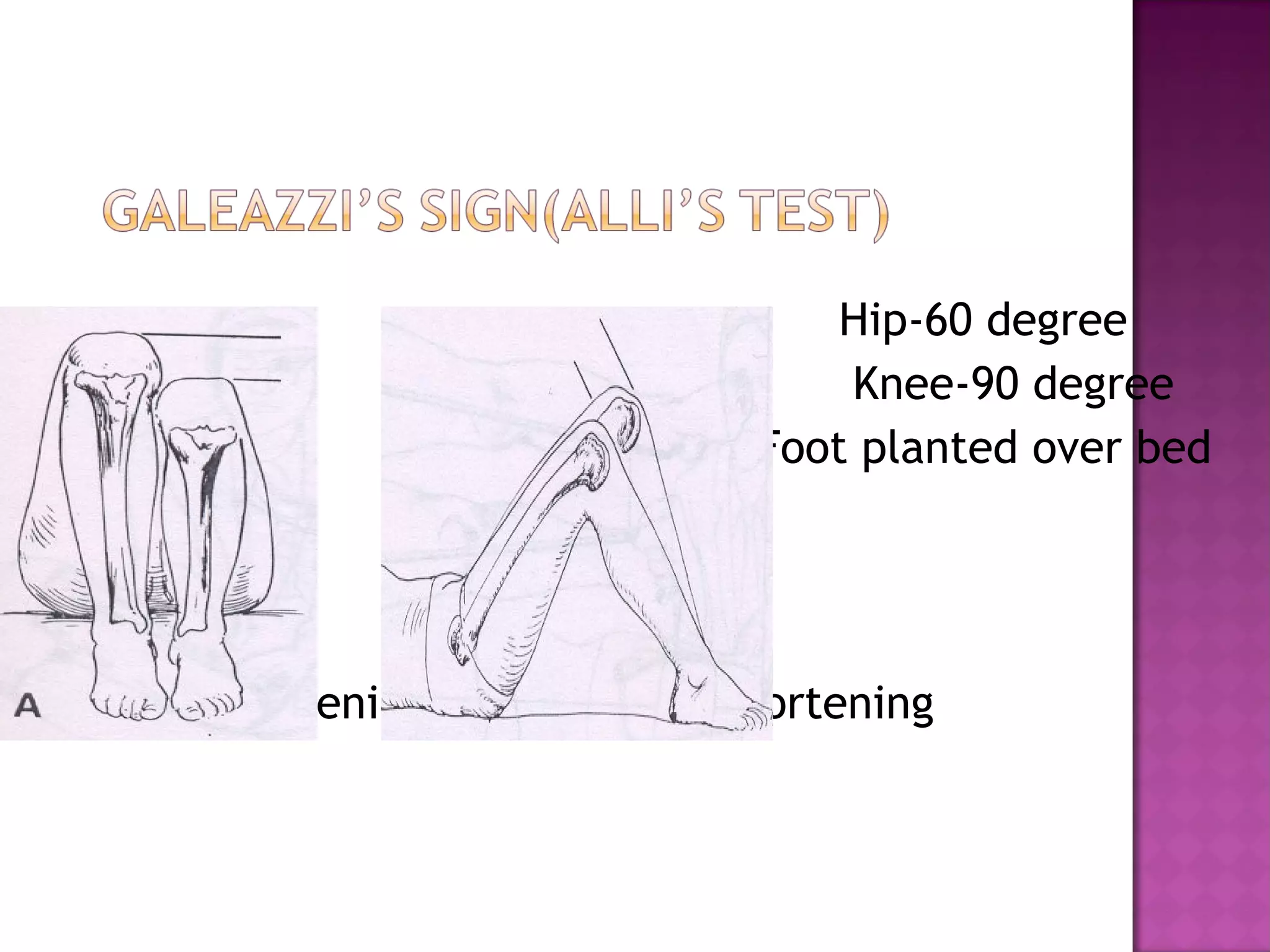                                     Hip-60 degree
                                    Knee-90 degree
                                Foot planted over bed




   Tibial shortening   Femoral shortening
 