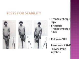    Trendelenberg’s
    sign
   Friedrich
    Trendelenberg’s
    1895

   Fulcrum-DDH

    Leverarm- # N/F
     Power-Polio
    myelitis
 