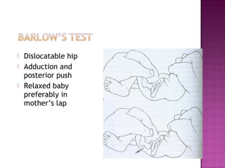    Dislocatable hip
   Adduction and
    posterior push
   Relaxed baby
    preferably in
    mother’s lap
 