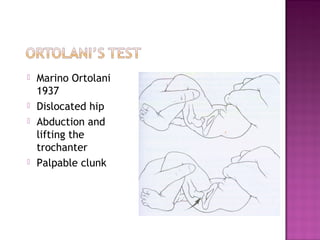    Marino Ortolani
    1937
   Dislocated hip
   Abduction and
    lifting the
    trochanter
   Palpable clunk
 