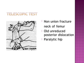    Non union fracture
    neck of femur
   Old unreduced
    posterior dislocation
   Paralytic hip
 