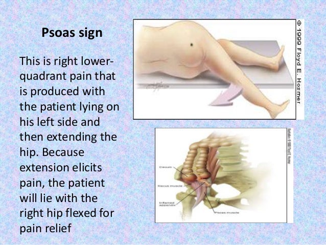 Case Presentation on Ruptured App