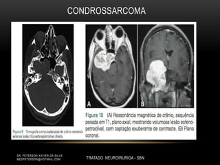 CONDROSSARCOMA
DR. PETERSON XAVIER DA SILVA
MEDPETERSON@HOTMAIL.COM TRATADO NEUROIRURIGA - SBN
 