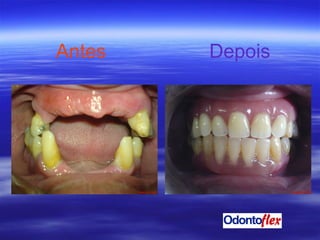 Antes   Depois 