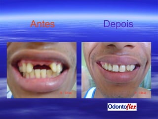 Antes   Depois 