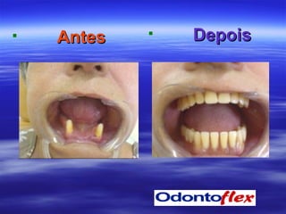 Antes Depois 