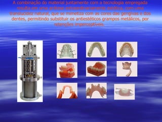 A combinação do material juntamente com a tecnologia empregada resulta em uma prótese extraordinariamente estética, com uma translucidez natural, que se mimetiza com as cores das gengivas e dos dentes, permitindo substituir os antiestéticos grampos metálicos, por retenções imperceptíveis.  