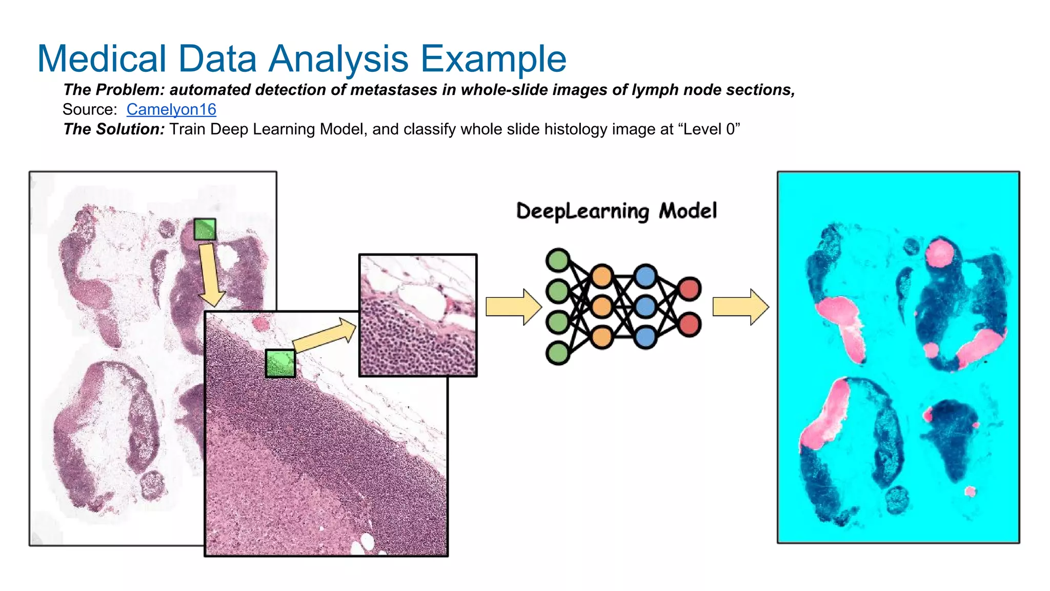 The Problem: automated detection of metastases in whole-slide images of lymph node sections,
Source: Camelyon16
The Solution: Train Deep Learning Model, and classify whole slide histology image at “Level 0”
Medical Data Analysis Example
 
