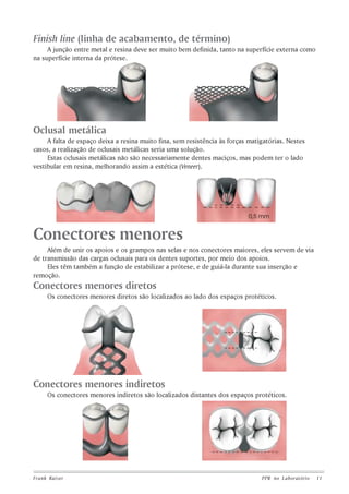 Finish line (linha de acabamento, de término)
A junção entre metal e resina deve ser muito bem definida, tanto na superfície externa como
na superfície interna da prótese.

Oclusal metálica
A falta de espaço deixa a resina muito fina, sem resistência às forças matigatórias. Nestes
casos, a realização de oclusais metálicas seria uma solução.
Estas oclusais metálicas não são necessariamente dentes maciços, mas podem ter o lado
vestibular em resina, melhorando assim a estética (Veneer).

Conectores menores
Além de unir os apoios e os grampos nas selas e nos conectores maiores, eles servem de via
de transmissão das cargas oclusais para os dentes suportes, por meio dos apoios.
Eles têm também a função de estabilizar a prótese, e de guiá-la durante sua inserção e
remoção.

Conectores menores diretos
Os conectores menores diretos são localizados ao lado dos espaços protéticos.

Conectores menores indiretos
Os conectores menores indiretos são localizados distantes dos espaços protéticos.

Frank Kaiser

PPR no L aboratório

11

 