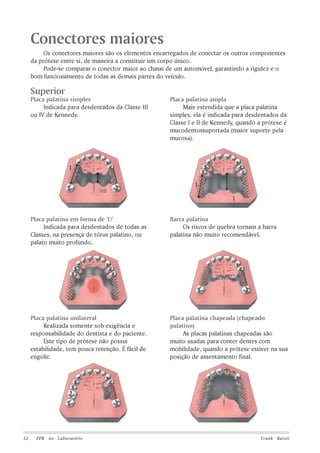 Conectores maiores
Os conectores maiores são os elementos encarregados de conectar os outros componentes
da prótese entre si, de maneira a constituir um corpo único.
Pode-se comparar o conector maior ao chassi de um automóvel, garantindo a rigidez e o
bom funcionamento de todas as demais partes do veículo.

Superior
Placa palatina simples
Indicada para desdentados da Classe III
ou IV de Kennedy.

Placa palatina em forma de ‘U’
Indicada para desdentados de todas as
Classes, na presença de tórus palatino, ou
palato muito profundo.

Barra palatina
Os riscos de quebra tornam a barra
palatina não muito recomendável.

Placa palatina unilateral
Realizada somente sob exigência e
responsabilidade do dentista e do paciente.
Este tipo de prótese não possui
estabilidade, tem pouca retenção. É fácil de
engolir.

12

Placa palatina ampla
Mais estendida que a placa palatina
simples, ela é indicada para desdentados da
Classe I e II de Kennedy, quando a prótese é
mucodentossuportada (maior suporte pela
mucosa).

Placa palatina chapeada (chapeado
palatino)
As placas palatinas chapeadas são
muito usadas para conter dentes com
mobilidade, quando a prótese estiver na sua
posição de assentamento final.

PPR no Laboratório

Frank Kaiser

 