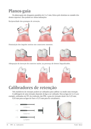 Planos-guia
Os planos-guia são desgastes paralelos de 2 a 3 mm, feitos pelo dentista no esmalte dos
dentes suportes. Eles podem ter várias indicações:
Reciprocidade dos grampos de retenção.

Diminuição dos ângulos mortos nos conectores menores.

Adequação da inserção do conector maior, na presença de dentes lingualizados.

Calibradores de retenção
Três medidores de retenção podem ser utilizados para calibrar ou medir uma retenção.
A calibragem de uma retenção depende da liga a ser utilizada. Para as ligas de Co-Cr por
exemplo, utilizadas em 95% da confecção das PPR, o grau de retenção ideal é de 0,25 mm.
0,50 mm para as ligas de Ouro e 0,75 mm para fio ortodôntico.

16

PPR no Laboratório

Frank Kaiser

 
