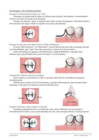 Grampos circunferenciais
Grampo circunferencial de Ackers ou “GCA”
O grampo circunferencial de Ackers é indicado para molares, pré-molares e eventualmente
caninos, nos casos da Classe III de Kennedy.
O braço de oposição, rígido, é indicado para todos os tipos de grampos e não deve invadir a
área retentiva. Ele segue a linha do equador sem nunca ultrapassá-la.

Grampo de ação posterior (Back-action ou Nally & Martinet)
O nome “Ação posterior”, ou “Back-action”, vem do fato de que este tipo de grampo dá uma
certa flexibilidade, uma “ação” nas selas posteriores, através do conector maior.
Dentro da família dos grampos circunferenciais, o Nally & Martinet é o grampo mais
indicado para extremidades livres, casos da Classe I e II de Kennedy.

Grampo M.D. (Mesial, Distal) ou Equipoise
Sobre caninos ou pré-molares, o MD é o grampo mais discreto da família dos grampos
circunferenciais.
Indicado para a Classe III ou IV de Kennedy, o grampo MD precisa de uma retenção distal
suficiente, e não pode ser indicado numa extremidade livre.

Mesial

Distal
Vista distal

Grampo Geminado, Ackers Duplo ou Bonwill
O grampo geminado pode ser considerado como uma combinação de dois grampos
circunferencial de Ackers, com a particularidade de criar uma retenção anterior e outra posterior.

Frank Kaiser

PPR no L aboratório

5

 