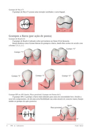 Grampo de Ney n°1
O grampo de Ney n°1 possui uma retenção vestibular e outra lingual.

Grampos a Barra (por ação de ponta)
Grampo de Roach (T)
O grampo de Roach é indicado sobre pré-molares na Classe III de Kennedy.
Roach idealizou cinco formas básicas de grampos a barra, dando-lhes nomes de acordo com
a forma: T, U, L, I, C.
Grampo “U”
Grampo “T”

Grampo “I”

Grampo “L”

Grampo “C”

Grampo RPI ou API (Apoio, Placa proximal, Grampo em forma de I)
O grampo API é o grampo a barra mais indicado para casos de extremidade livre. Devido a
seus três componentes, ele dá uma certa flexibilidade nas selas através do conector maior, função
similar ao grampo de ação posterior.
Apoio
I

Placa proximal

P

A

6

PPR no Laboratório

Grampo em “I”

Frank Kaiser

 