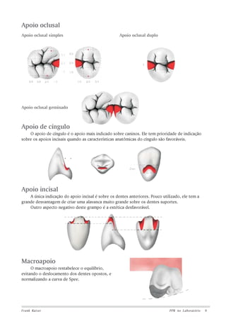 Apoio oclusal
Apoio oclusal simples

Apoio oclusal duplo

Apoio oclusal geminado

Apoio de cíngulo
O apoio de cíngulo é o apoio mais indicado sobre caninos. Ele tem prioridade de indicação
sobre os apoios incisais quando as características anatômicas do cíngulo são favoráveis.

Apoio incisal
A única indicação do apoio incisal é sobre os dentes anteriores. Pouco utilizado, ele tem a
grande desvantagem de criar uma alavanca muito grande sobre os dentes suportes.
Outro aspecto negativo deste grampo é a estética desfavorável.

Macroapoio
O macroapoio restabelece o equilíbrio,
evitando o deslocamento dos dentes opostos, e
normalizando a curva de Spee.

Frank Kaiser

PPR no L aboratório

9

 