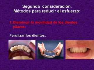 Segunda  consideración. Métodos para reducir el esfuerzo: <ul><li>Disminuir la movilidad de los dientes pilares: </li></ul...