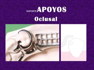 SOPORTE   APOYOS Oclusal  