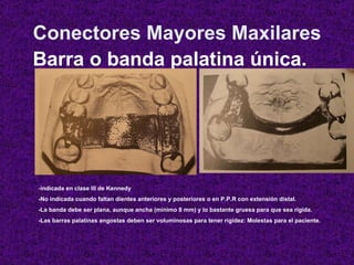 Conectores Mayores Maxilares Barra o banda palatina única. - indicada en clase III de Kennedy -No indicada cuando faltan d...