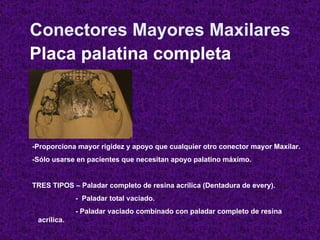 Conectores Mayores Maxilares Placa palatina completa -Proporciona mayor rigidez y apoyo que cualquier otro conector mayor ...